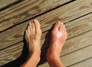 Soluzioni e cure per l’alluce valgo alluce valgo